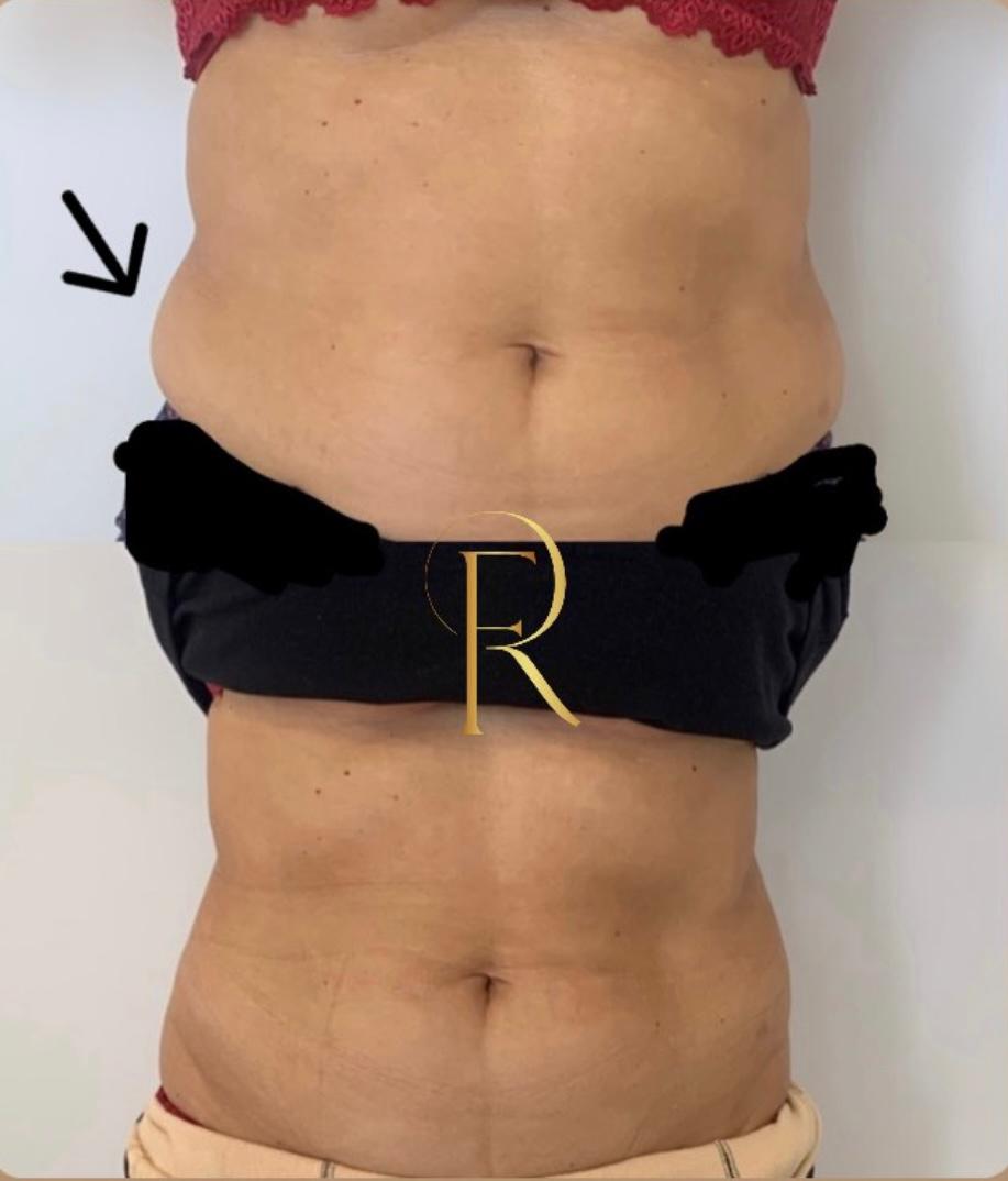 Registro antes e depois de tratamento estético