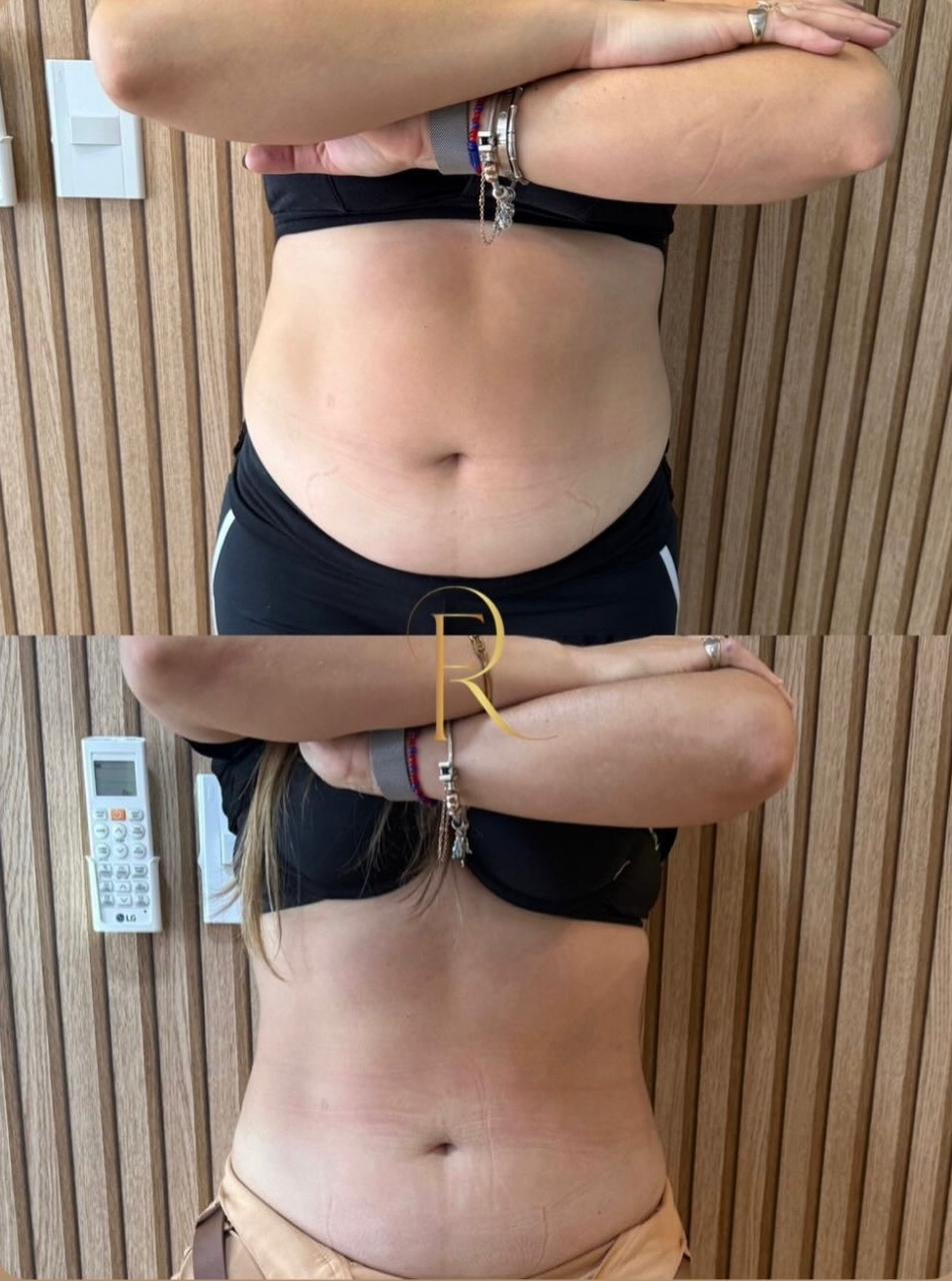 Registro antes e depois de tratamento estético
