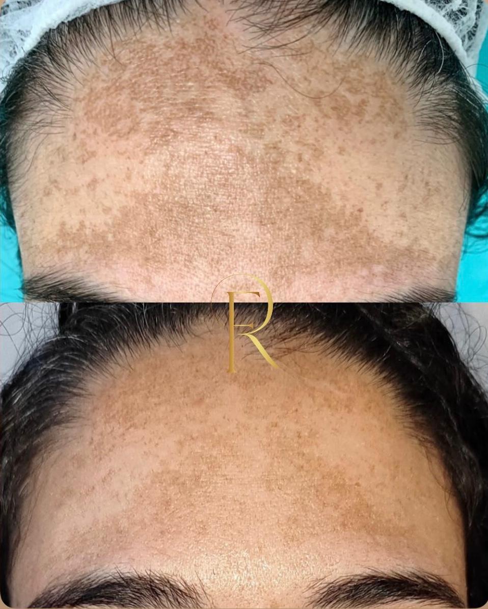Registro antes e depois de tratamento estético