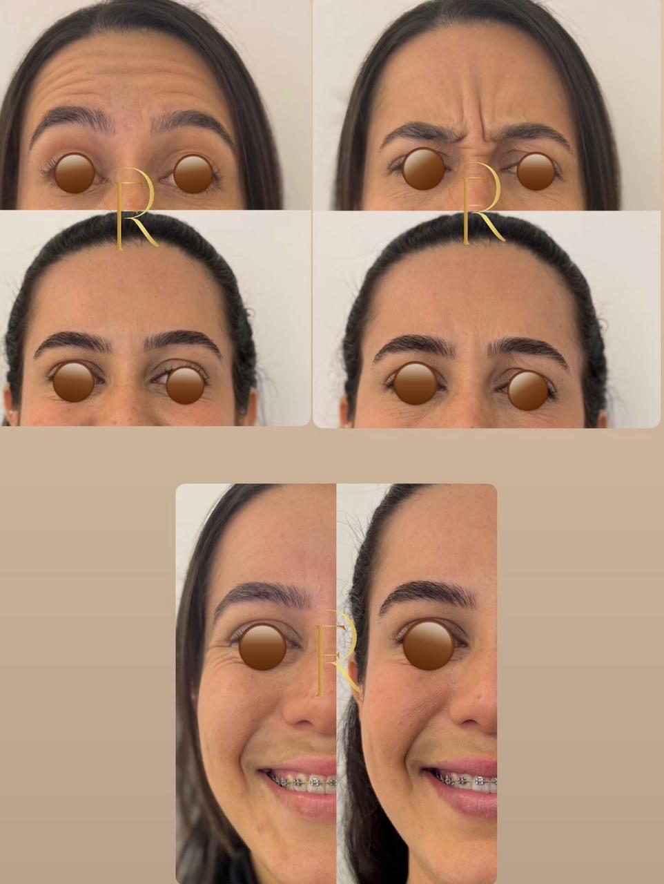 Registro antes e depois de tratamento estético