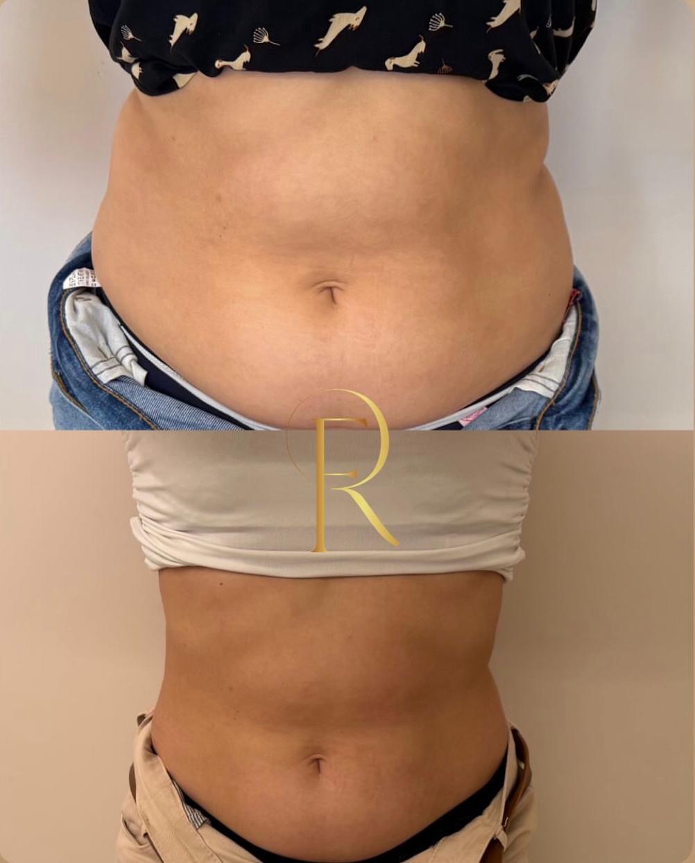 Registro antes e depois de tratamento estético