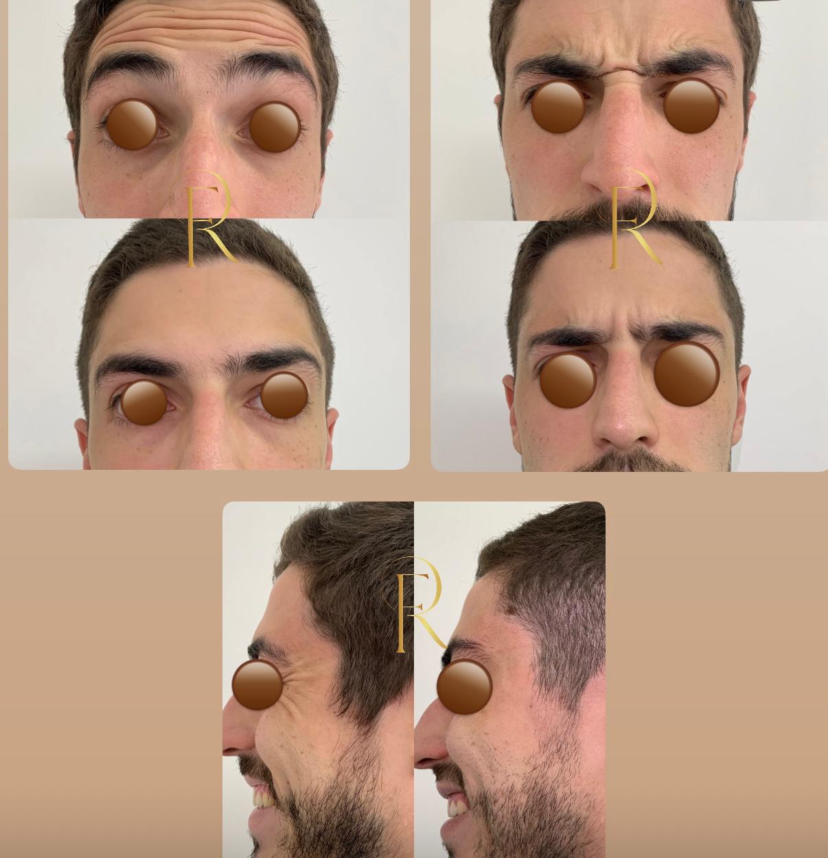 Registro antes e depois de tratamento estético