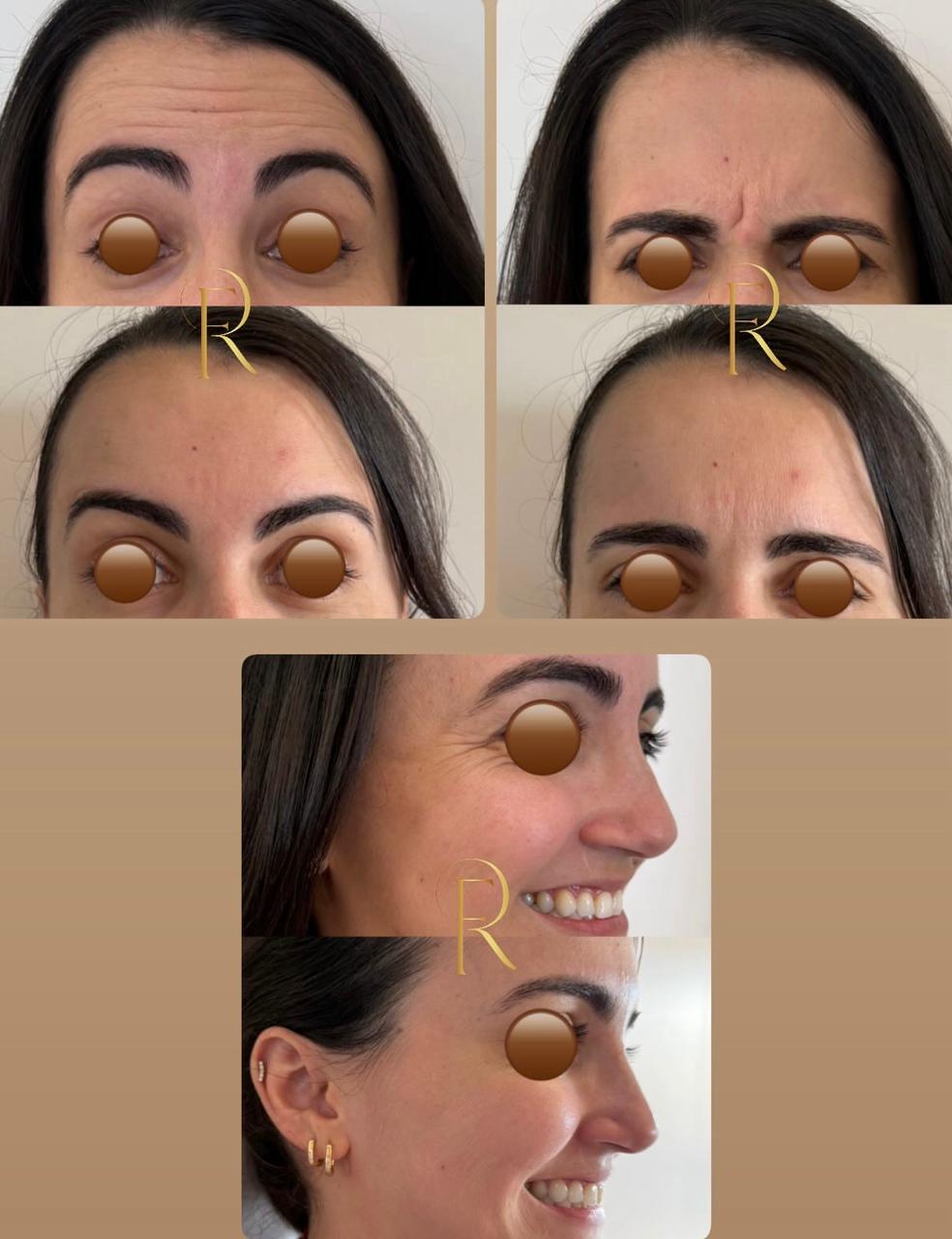 Registro antes e depois de tratamento estético