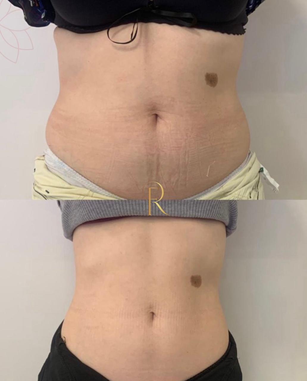 Registro antes e depois de tratamento estético