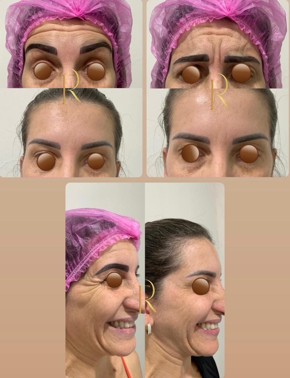 Registro antes e depois de tratamento estético