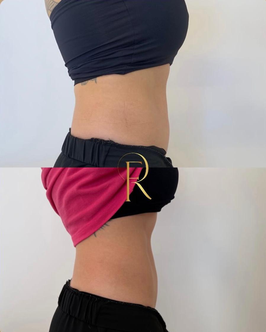Registro antes e depois de tratamento estético