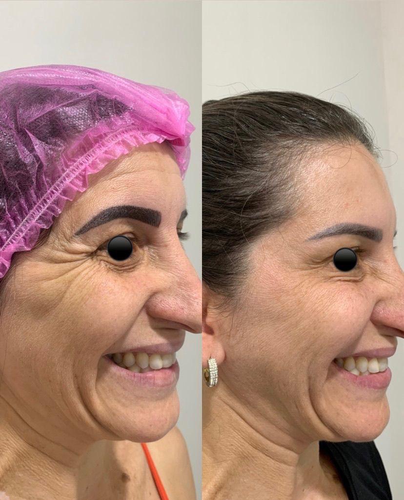Registro antes e depois de tratamento estético