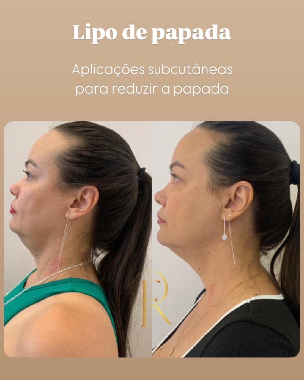 Registro antes e depois de tratamento estético