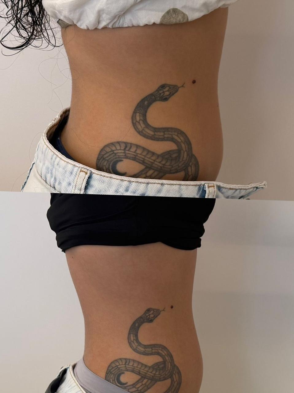 Registro antes e depois de tratamento estético