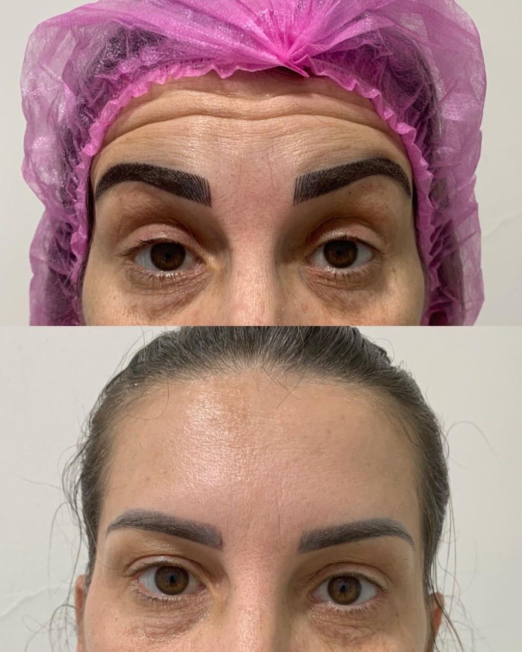 Registro antes e depois de tratamento estético