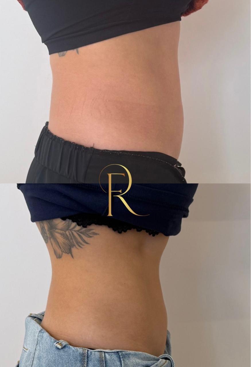 Registro antes e depois de tratamento estético