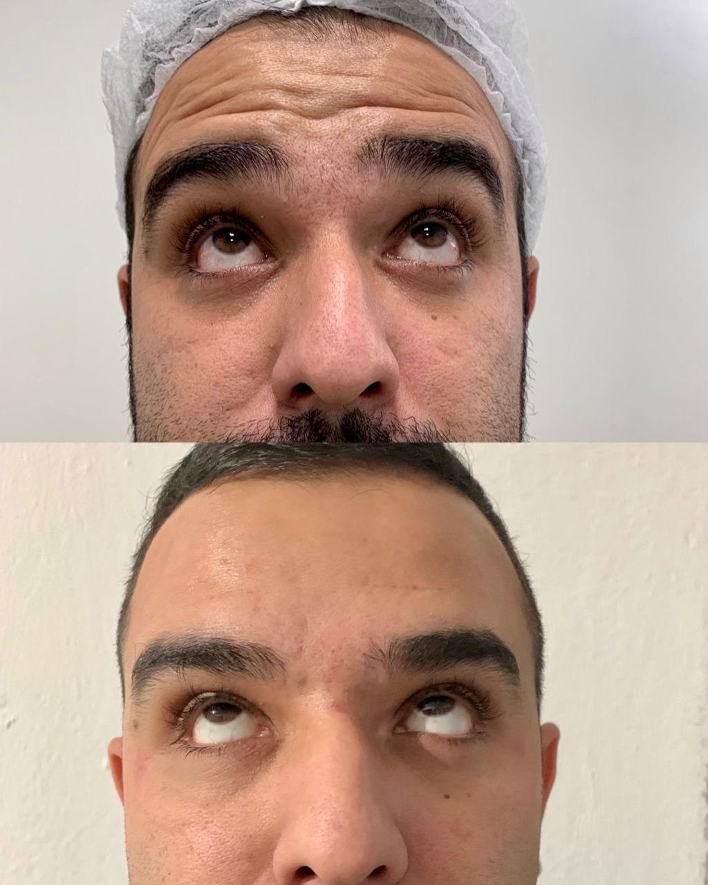 Registro antes e depois de tratamento estético