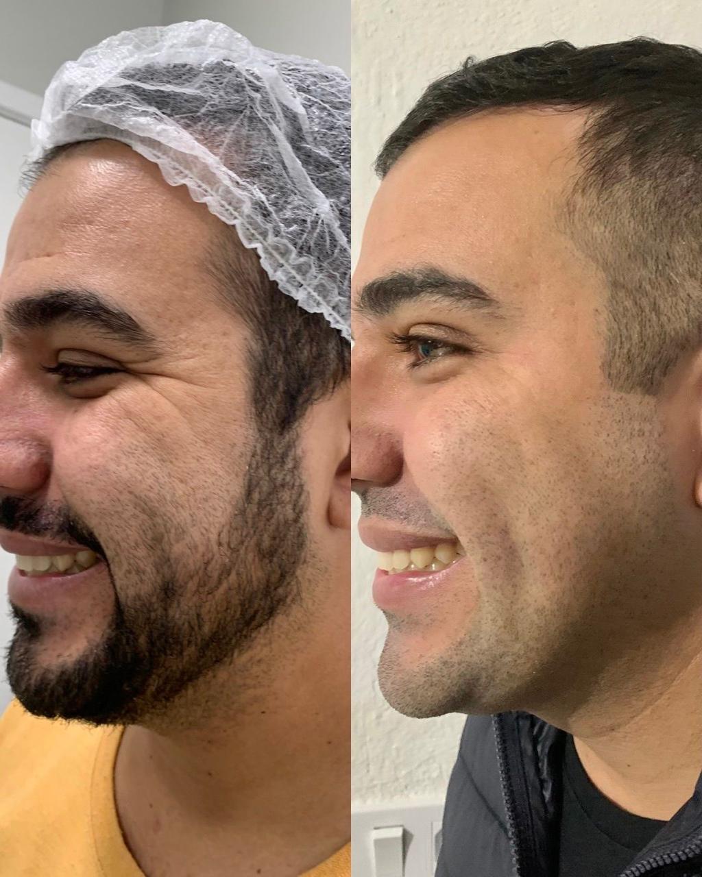 Registro antes e depois de tratamento estético