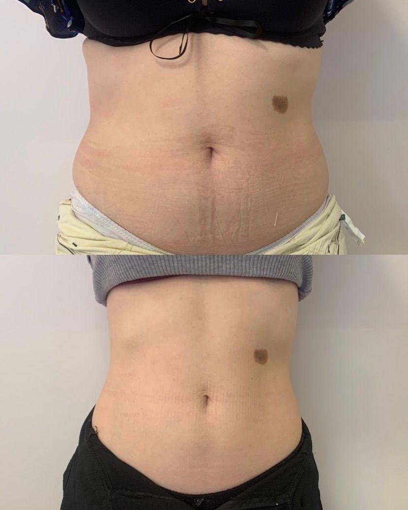 Registro antes e depois de tratamento estético