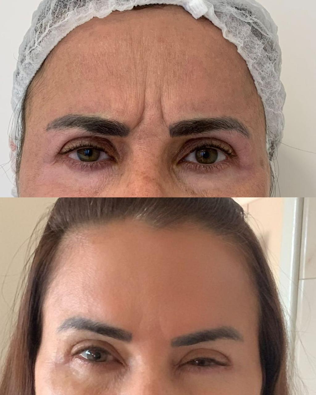 Registro antes e depois de tratamento estético