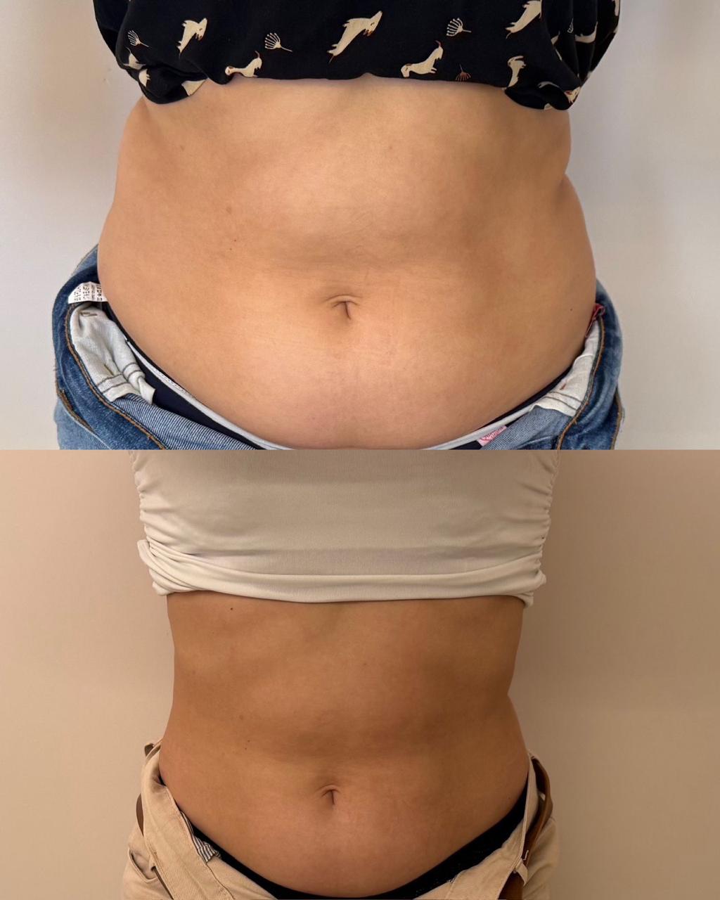 Registro antes e depois de tratamento estético