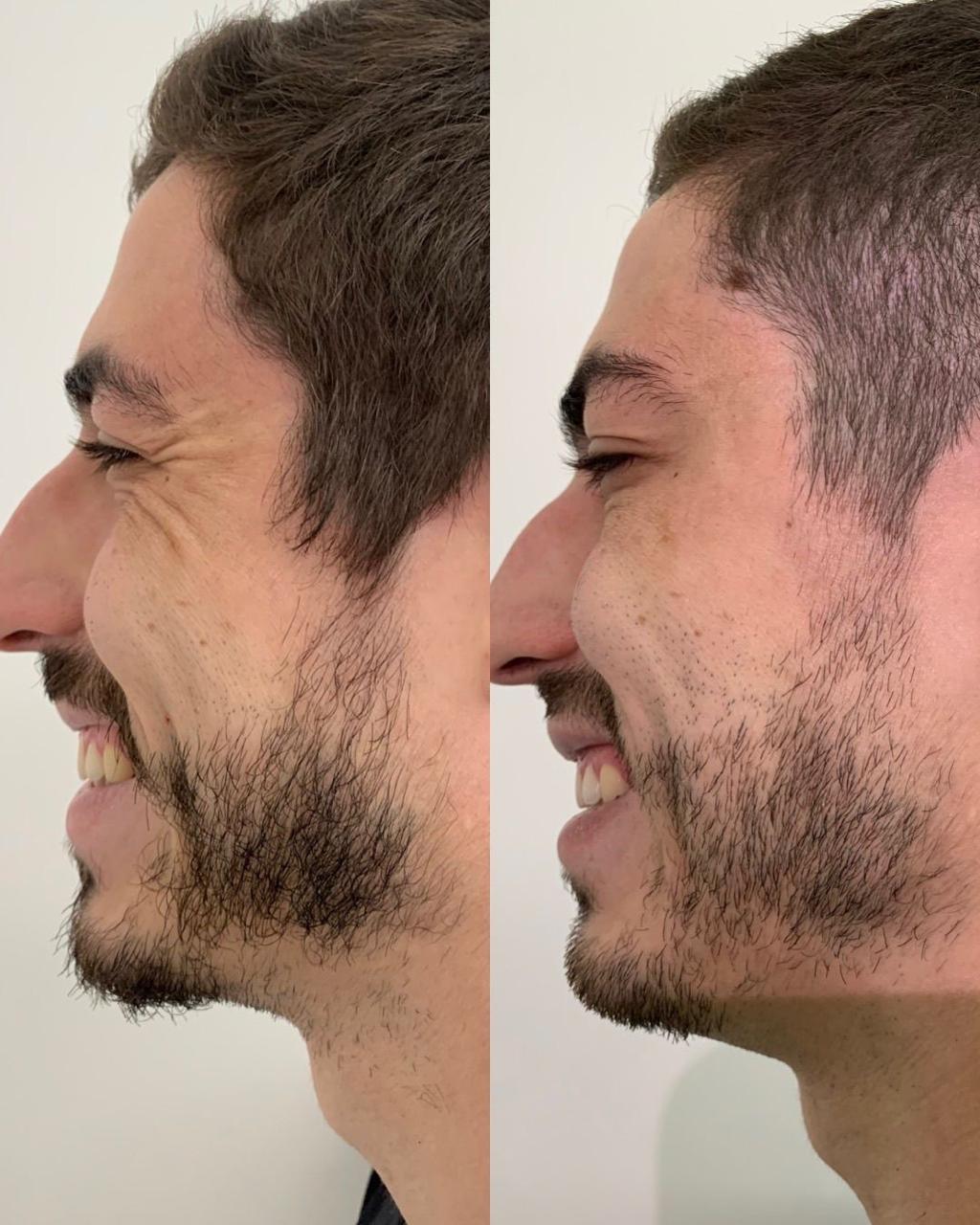 Registro antes e depois de tratamento estético