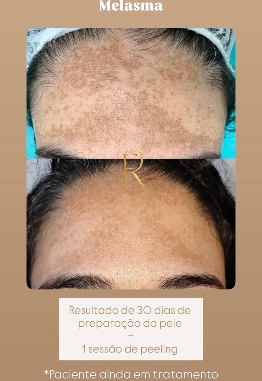 Registro antes e depois de tratamento estético