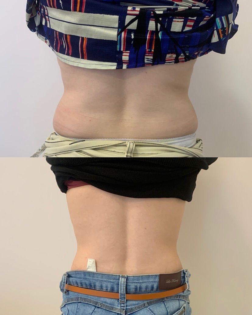 Registro antes e depois de tratamento estético